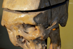 Cráneo con Acromegalia. Se trata de una enfermedad que se desarrolla por una exagerada secreción de la hormona del crecimiento